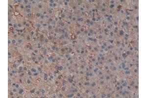 IHC-P analysis of Human Liver cancer Tissue, with DAB staining. (Hemoglobin Subunit beta antibody  (AA 1-147))