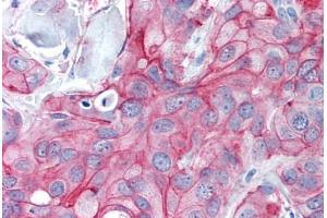 Human Breast, Carcinoma (formalin-fixed, paraffin-embedded) stained with ERBB2 antibody ABIN305740 at 5 ug/ml followed by biotinylated goat anti-rabbit IgG secondary antibody ABIN481713, alkaline phosphatase-streptavidin and chromogen.