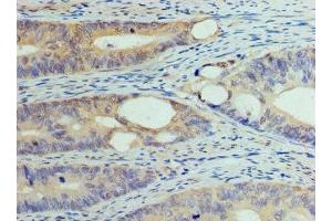 Immunohistochemistry of paraffin-embedded human colon cancer using ABIN7150104 at dilution of 1:100 (DNMT1 antibody  (AA 1288-1632))