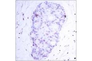 Immunohistochemistry analysis of paraffin-embedded human breast carcinoma, using NF-kappaB p105/p50 (Phospho-Ser907) Antibody. (NFKB1 antibody  (pSer907))