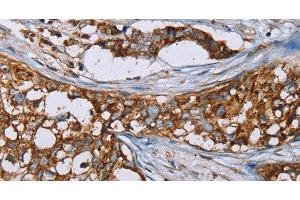 Immunohistochemistry of paraffin-embedded Human breast cancer using BMP6 Polyclonal Antibody at dilution of 1:50