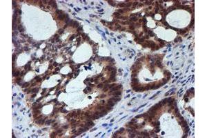 Immunohistochemical staining of paraffin-embedded Adenocarcinoma of Human colon tissue using anti-RUVBL2 mouse monoclonal antibody. (RUVBL2 antibody  (AA 113-370))