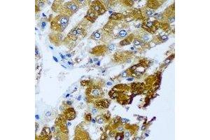 Immunohistochemical analysis of BLVRB staining in human liver cancer formalin fixed paraffin embedded tissue section. (BLVRB antibody)