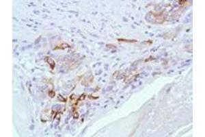 Anti BAX Monoclonal Antibody - Immunohistochemistry  anti-BAX monoclonal antibody (Rabbit) was used to detect BAX in Human Skin Squamous Cell Carcinoma.