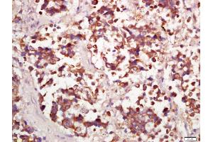 Formalin-fixed and paraffin embedded human lung carcinoma labeled with Anti-PPP4C Polyclonal Antibody, Unconjugated (ABIN669261) at 1:200 followed by conjugation to the secondary antibody and DAB staining