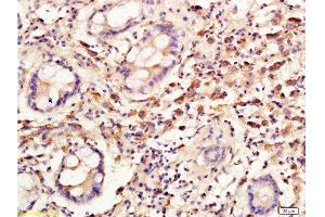 Formalin-fixed and paraffin embedded: human colon carcinoma labeled with Anti-Cyclin C Polyclonal Antibody, Unconjugated  at 1:300, followed by conjugation to the secondary antibody and DAB staining (Cyclin C antibody  (AA 23-100))