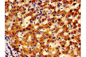 IHC image of ABIN7143578 diluted at 1:600 and staining in paraffin-embedded human liver cancer performed on a Leica BondTM system. (AFG1-Like ATPase (AFG1L) (AA 14-313) antibody)