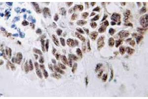 Immunohistochemistry (IHC) analyzes of ZIP-kinase antibody in paraffin-embedded human lung carcinoma tissue. (DAPK3 antibody)