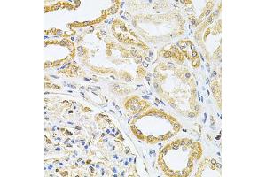Immunohistochemistry of paraffin-embedded human kidney cancer using VAPB Antibody (ABIN1876551) at dilution of 1:200 (40x lens). (VAPB antibody)