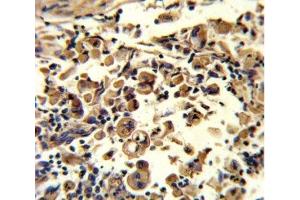 IHC analysis of FFPE human lung carcinoma stained with SOD3 antibody (SOD3 antibody  (AA 7-36))