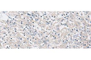 Immunohistochemistry of paraffin-embedded Human liver cancer tissue using FBXO16 Polyclonal Antibody at dilution of 1:60(x200) (FBXO16 antibody)