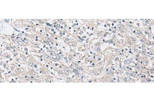 Immunohistochemistry of paraffin-embedded Human liver cancer tissue using FBXO16 Polyclonal Antibody at dilution of 1:60(x200)