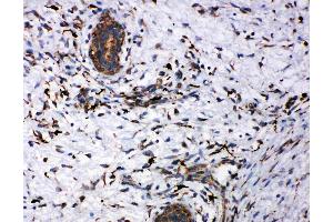 Anti-CD163 antibody, IHC(P): Human Mammary Cancer Tissue (CD163 antibody  (AA 1056-1165))