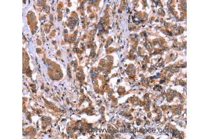 Immunohistochemistry of Human ovarian cancer using HRG Polyclonal Antibody at dilution of 1:50 (HRG antibody)