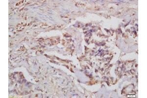 Formalin-fixed and paraffin embedded human colon carcinoma labeled with Rabbit Anti-CARD15 Polyclonal Antibody, Unconjugated  at 1:200 followed by conjugation to the secondary antibody and DAB staining (NOD2 antibody  (AA 251-350))