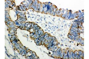 Anti- Peroxiredoxin 3 Picoband antibody,IHC(P) IHC(P): Human Intestinal Cancer Tissue (Peroxiredoxin 3 antibody  (AA 110-256))