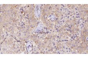 ABIN6273329 at 1/100 staining Human thyroid cancer tissue by IHC-P. (TCTN2 antibody  (Internal Region))