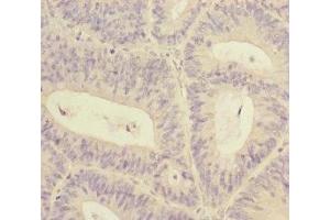 Immunohistochemistry of paraffin-embedded human colon cancer using ABIN7170629 at dilution of 1:100 (RBM17 antibody  (AA 1-240))