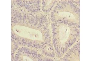 Immunohistochemistry of paraffin-embedded human colon cancer using ABIN7170629 at dilution of 1:100