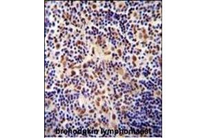 TIGD3 antibody (C-term) (ABIN654995 and ABIN2844630) immunohistochemistry analysis in formalin fixed and paraffin embedded human hodgkin lymphoma followed by peroxidase conjugation of the secondary antibody and DAB staining. (TIGD3 antibody  (C-Term))