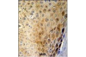 GSD Antibody (N-term) (ABIN651081 and ABIN2840063) IHC analysis in forlin fixed and paraffin embedded hun skin carcino followed by peroxidase conjugation of the secondary antibody and DAB staining. (Gasdermin A antibody  (N-Term))