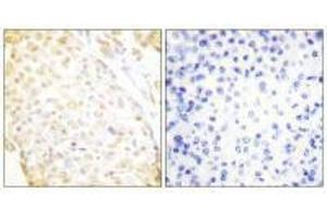 Immunohistochemistry analysis of paraffin-embedded human breast carcinoma tissue, using NKX3. (NKX3-1 antibody  (N-Term))