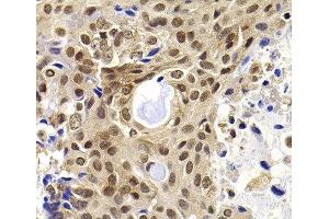 Immunohistochemistry of paraffin-embedded Human oophoroma using PHF19 Polyclonal Antibody at dilution of 1:100 (40x lens). (PHF19 antibody)