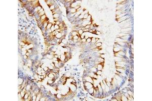 IHC-P: SPARC antibody testing of human intestinal cancer tissue (SPARC antibody  (AA 284-303))