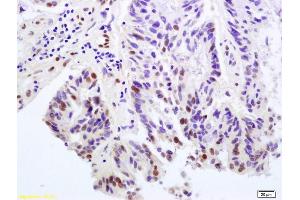 Formalin-fixed and paraffin embedded human rectal carcinoma labeled with Anti-Phospho-Histone H2A. (H2AFX antibody  (pTyr143))