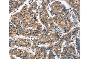 Immunohistochemistry of Human breast cancer using ALOX15 Polyclonal Antibody at dilution of 1:60 (ALOX15 antibody)