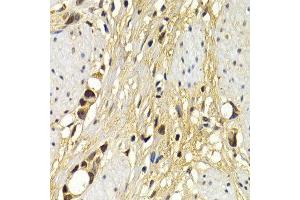 Immunohistochemistry of paraffin-embedded human stomach cancer using UAP1 antibody at dilution of 1:200 (400x lens).