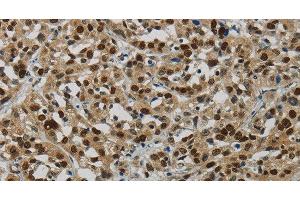 Immunohistochemistry of paraffin-embedded Human esophagus cancer tissue using DNA Ligase1 Polyclonal Antibody at dilution 1:70 (LIG1 antibody)