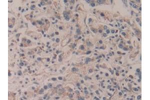 IHC-P analysis of Human Prostate cancer Tissue, with DAB staining.