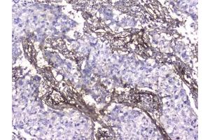 IHC testing of FFPE human lung cancer with Collagen IV antibody at 2ug/ml. (Collagen IV antibody  (AA 1445-1669))