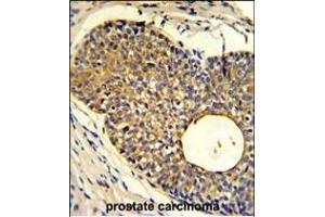 Formalin-fixed and paraffin-embedded human prostate carcinoma reacted with PHO1 Antibody (N-term), which was peroxidase-conjugated to the secondary antibody, followed by DAB staining. (Phosphate Transporter PHO1 (AA 1-30), (N-Term) antibody)