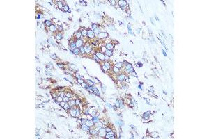 Immunohistochemistry of paraffin-embedded Human breast cancer using GSTT1 Rabbit pAb (ABIN3021870, ABIN3021871, ABIN3021872, ABIN1512971 and ABIN6216656) at dilution of 1:100 (40x lens). (GSTT1 antibody  (AA 1-240))