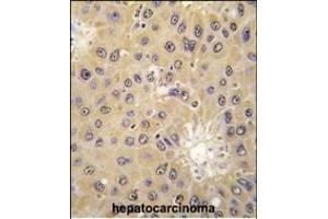 Formalin-fixed and paraffin-embedded human hepatocarcinoma tissue reacted with ACAT1 antibody (C-term) (ABIN391807 and ABIN2841659) , which was peroxidase-conjugated to the secondary antibody, followed by DAB staining. (ACAT1 antibody  (C-Term))