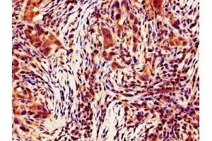 IHC image of ABIN7146946 diluted at 1:700 and staining in paraffin-embedded human pancreatic cancer performed on a Leica BondTM system. (Caspase 4 antibody  (AA 82-226))