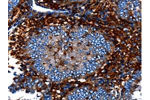The image on the left is immunohistochemistry of paraffin-embedded Human cervical cancer tissue using ABIN7128981(CNGA2 Antibody) at dilution 1/25, on the right is treated with fusion protein. (CNGA2 antibody)