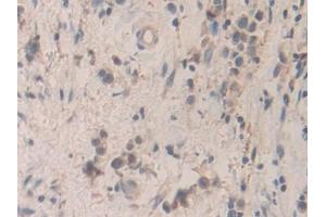 Detection of SMC3 in Human Stomach cancer Tissue using Polyclonal Antibody to Structural Maintenance Of Chromosomes Protein 3 (SMC3) (SMC3 antibody  (AA 994-1181))