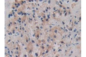 Detection of ROS1 in Human Prostate cancer Tissue using Polyclonal Antibody to C-Ros Oncogene 1, Receptor Tyrosine Kinase (ROS1) (ROS1 antibody  (AA 1945-2222))