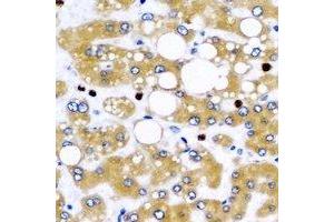 Immunohistochemical analysis of NFS1 staining in human liver cancer formalin fixed paraffin embedded tissue section.