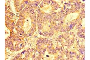 Immunohistochemistry of paraffin-embedded human colon cancer using ABIN7151966 at dilution of 1:100