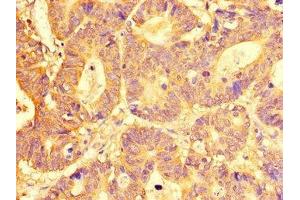 Immunohistochemistry of paraffin-embedded human colon cancer using ABIN7151966 at dilution of 1:100 (SLC29A1 antibody  (AA 228-291))