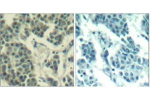 Immunohistochemical analysis of paraffin-embedded human breast carcinoma tissue using Her3/ErbB3(Phospho-Tyr1328) Antibody(left) or the same antibody preincubated with blocking peptide(right). (ERBB3 antibody  (pTyr1328))