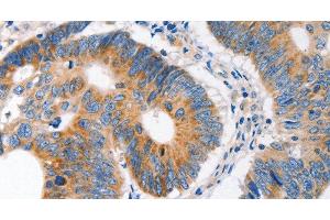 Immunohistochemistry of paraffin-embedded Human colon cancer tissue using MC1R Polyclonal Antibody at dilution 1:100 (MC1 Receptor antibody)