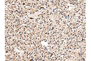 The image on the left is immunohistochemistry of paraffin-embedded Human prostate cancer tissue using ABIN7127989(PPIL1 Antibody) at dilution 1/30, on the right is treated with fusion protein. (PPIL1 antibody)