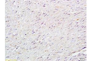 Formalin-fixed and paraffin: human cervical carcinoma labeled with Anti-RB1CC1 Polyclonal Antibody , Unconjugated at 1:200 followed by conjugation to the secondary antibody and DAB staining (FIP200 antibody  (AA 501-600))