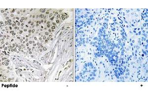 Immunohistochemistry analysis of paraffin-embedded human lung carcinoma tissue, using EFTUD2 polyclonal antibody .