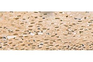 Immunohistochemistry of paraffin-embedded Human cervical cancer tissue using FOXH1 Polyclonal Antibody at dilution of 1:40(x200) (FOXH1 antibody)